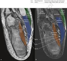 The deformity of the foot with abnormal pressure distribution on the plantar surface coupled with reduced or loss of sensation, makes the foot. 11 Axial Mri Images Of The Foot A T1 Weighted Image B T2 Weighted Download Scientific Diagram