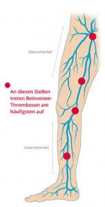 Eine thrombose (von „thrombus bzw. Thrombose Symptome Vorbeugung Behandlung
