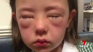 Food intolerance does not affect the immune system, although some symptoms may be the same as in food allergy. School Bullies Target Children With Food Allergies Daily Mail Online