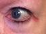 Rash On Outer Corner Of Eye
