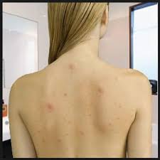 Azanis acne body spray bersedia membantu anda menghilangkan jerawat badan dengan berkesan. Cara Alami Hilangkan Bekas Jerawat Di Wajah Cara Menghilangkan Jerawat Punggung Secara Alami