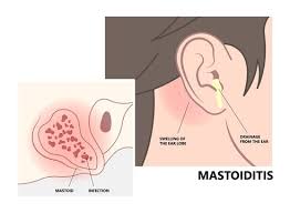 Image result for Mastoiditis