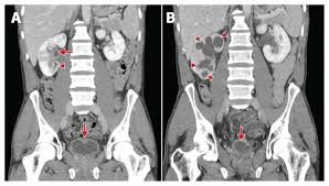 Image result for Genitourinary Tuberculosis