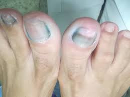 Baixe agora mesmo a foto fungo na unha e dermatite. Podologia Tratamento De Onicomicose Micose Na Unha A Laser Fisiofeet