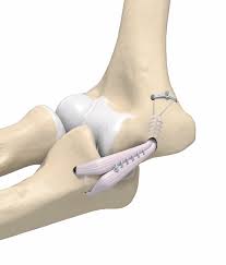 As a result, you may hear the term tommy john surgery when discussing ucl reconstruction surgery. Tommy John Surgery Ucl Injury Overview Dr Christopher Ahmad