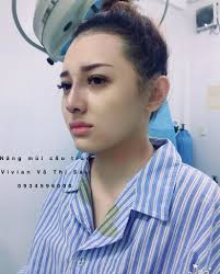 ☀️ Đây là hình ảnh khách của Vivian Beauty VIỆN THẨM MỸ đã  #Nâng_mũi_cấu_trúc_Lline. 🌨🌨 Khách lành da mát thịt nên mũi lên form  chuẩn đẹp Cao Tây 🧐 Theo dõi thêm