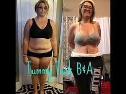 Video 2 Post Op Day 10 Before And After Pictures Youtube Tummy Tuck Pictures Tummy Tucks Tummy Tuck Surgery