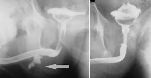 Image result for Retrograde Urethrogram