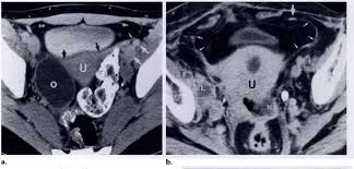 The angle between these two lines is the pelvic incidence (see angle x in figure above). Pdf Ct Anatomy Of The Female Pelvis A Second Look Semantic Scholar