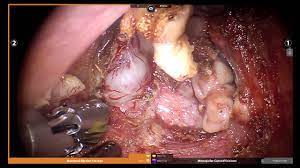 Surgery is a common treatment used to try to cure most prostate cancers. Full Robotic Prostate Cancer Removal With Expert Surgeon Naveen Kella Youtube