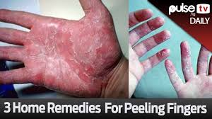 Review the treatment information pages for various causes of peeling skin on hands and feet: 3 Home Remedies For Peeling Fingers Pulse Daily Youtube
