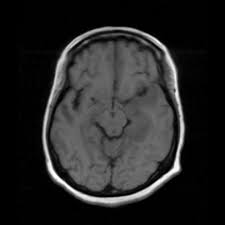 For a general discussion, and for links to other system specific manifestations, please refer to the article on hydatid disease. Hsv Encephalitis Radiology Case Radiopaedia Org