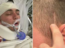 Insurance loophole leaves Bali scooter crash victim out of pocket