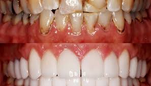 Image result for Oral Health