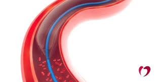 It restores blood flow to the heart muscle without for angioplasty, a long, thin tube (catheter) is put into a blood vessel and guided to the blocked coronary artery. Angioplasty And Stents To Open Blocked Blood Vessels Oklahoma Heart Hospital
