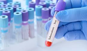 Image result for Tuberculosis Screening