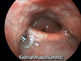 Image result for Reflux Laryngitis