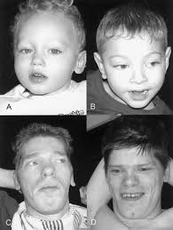 Allan-Herndon-Dudley Syndrome and the Monocarboxylate Transporter 8 (MCT8)  Gene