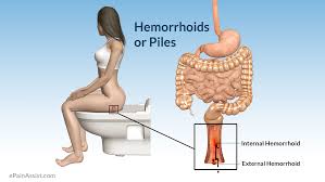 Image result for hemoroid human