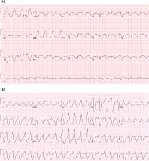 Many people who get myocarditis are otherwise. Virus Myocarditis An Overview Sciencedirect Topics