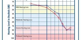 Hearing Loss Understanding The Audiogram