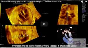 Introduction To Stic Obstetric Ultrasound 3d Ultrasound 4d Ultrasound