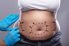When fat mass sharply decreases under the skin there is a kind of emptiness. Abdominoplasty Tummy Tuck Surgery Prep And Recovery