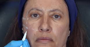 Marking Up For Cheek Filler