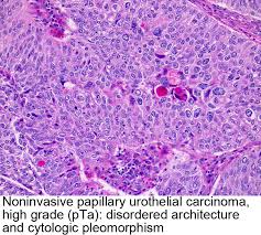 Pathology Outlines Urothelial Carcinoma Of Renal Pelvis