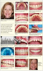 A lot of people with exercise bulimia will experience no negative consequences in the first months, and might even see a lifestyle. Bulimia Complex Etiology Challenging Treatment Dentistry Today