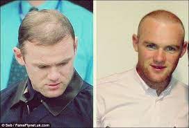 Weltmeisterfrisur benedikt höwedes ließ sich haare. Wayne Rooney Haartransplantation Vor Und Nach Dem Eingriff Manner Mode Hair Transplant Wayne Rooney Hair Transplant Cool Boys Haircuts