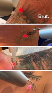 New york skin & vein is upstate new york's leading provider of laser tattoo removal. Free Tattoo Removal To Transform Lives Brut