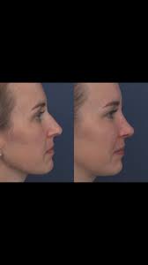 #wonderfulwednesday #humpday Subtle but effective. I guess this is what  they call #finesserhinoplasty What a wonderful result