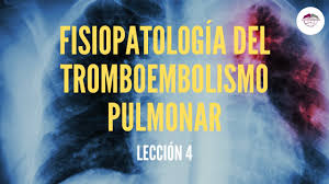 Que es una trombosis pulmonar. 4 Fisiopatologia Del Tromboembolismo Pulmonar Fisiopatologia Respiratoria Youtube