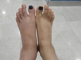 자신의 신발 사이즈 알아보는 법. ë‚˜ë„ í•œì˜ˆìŠ¬ì²˜ëŸ¼ ì˜ë£Œì‚¬ê³  ì¼ë°˜ì¸ì€ ì™¸ì³ë„ ë°˜í–¥ì´ ì—†ë‹¤ ì¹´ì¹´ì˜¤í†¡ ë‰´ìŠ¤