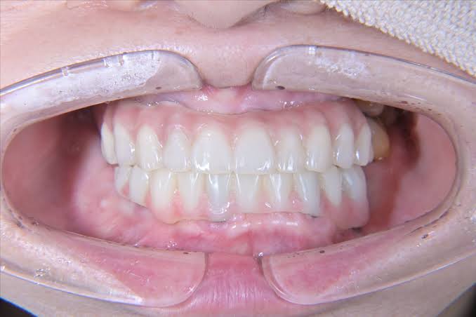 all on six implant bahcelievler
