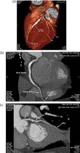 I've set them off in a computer the idiot's guide to detectors says they work by sending out radio signals that surround you with an electromagnetic field. Evaluation Of Coronary Stents Using Multidetector Ct Sciencedirect