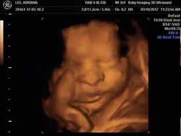 People tell us that we have the best 3d ultrasound photo gallery comparing our 3d ultrasound photos with photos after baby's birth.we hope you will agree. Xavier Isaiah Lee Last 3d Ultrasound 31 Weeks Youtube