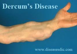 Dercum S Disease Causes Complications And Diagnosis
