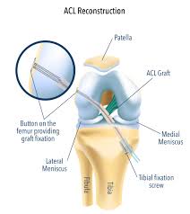 An acl specifies which users or system processes are granted access to objects. Acl Reconstruction Surgery Melbourne Acl Surgeon Dr Vishal Pai