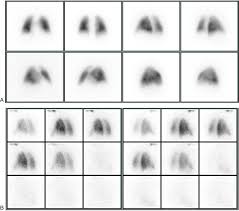 Image result for Ventilation Perfusion Scan