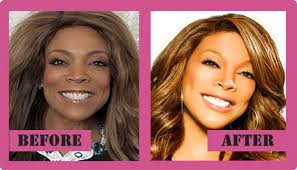That other celebrities come to her for advise before going under the knife. Wendy Williams Plastic Surgery The Before And After