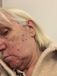 Fundraiser by Robyn Tully : Cryotherapy for my nans Trigeminal neuralgia