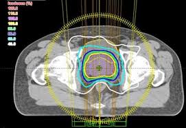 Image result for Intensity-Modulated Radiation Therapy