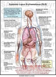 Lupus Symptoms Lupus Awareness Lupus Facts Lupus