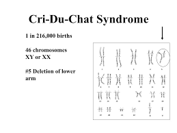 turners syndrome 1 in 5 000 births 45 chromosomes x only 23