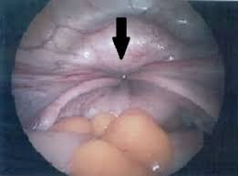 Image result for Uterine Inversion