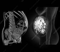 Volledige foetus, CT- en MRI-scans - Stockfoto - C018/0398 - Science Photo Library