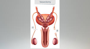 Embora a vasectomia seja considerada uma forma permanente de contracepção, os avanços na microcirurgia aumentaram o sucesso dos procedimentos de reversão da vasectomia. Vasectomia Sintonia Beneficios