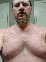 Has anyone experienced tumors and breakouts related to Agent Orange  exposure?